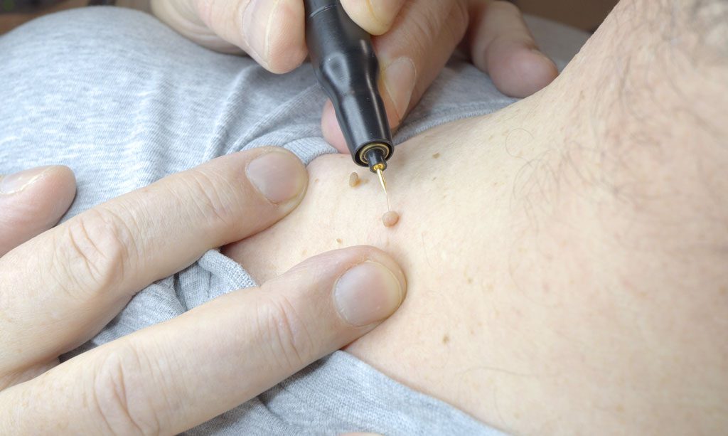 Behandlung mit dem Phlebolyser