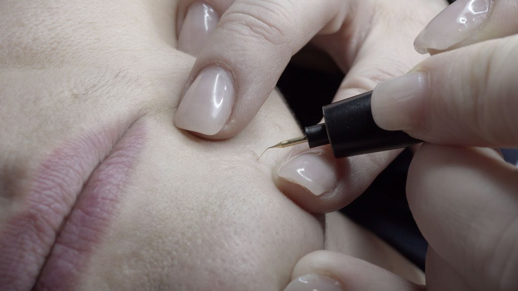 Behandlung eingewachsenes Haar